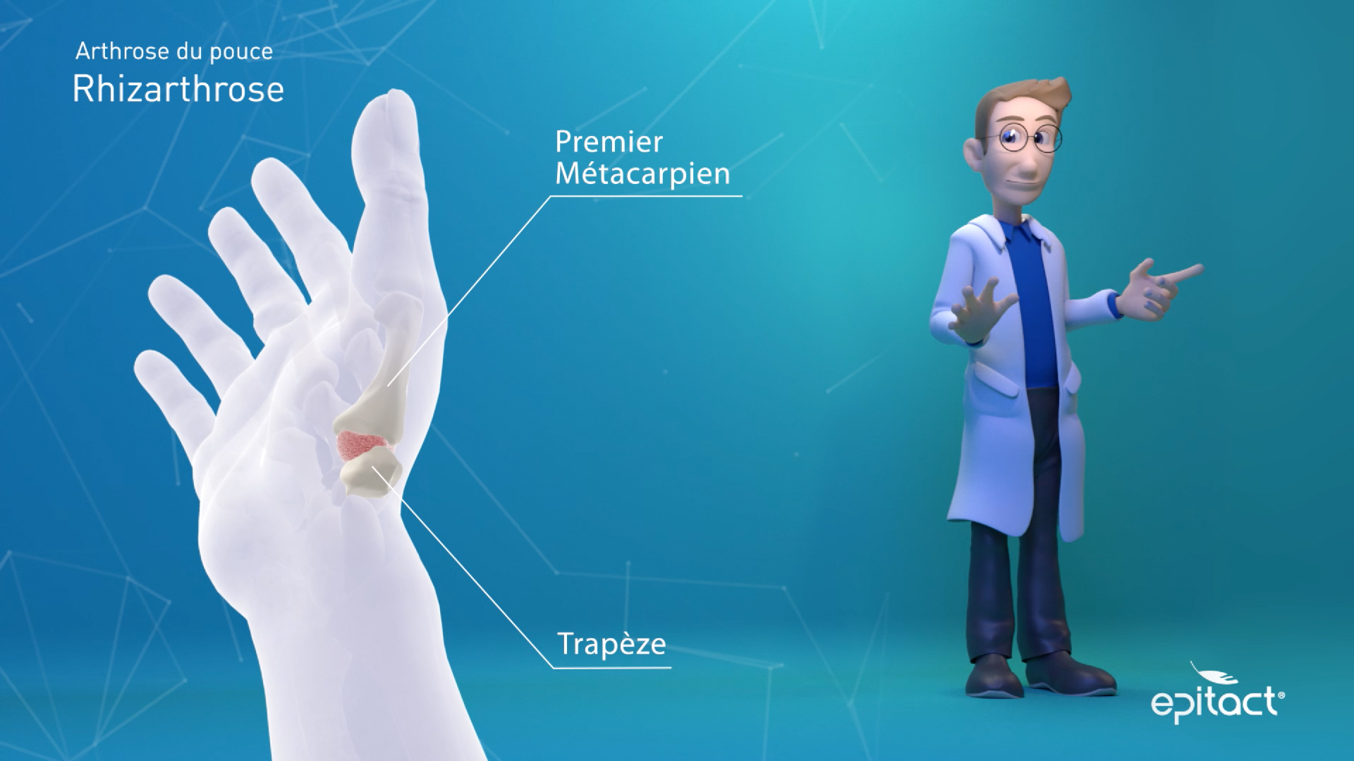 Rhizarthrose, Daumenarthrose