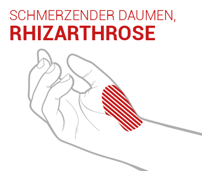rizarthrose epitact