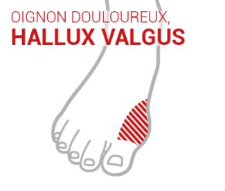 Hallux valgus