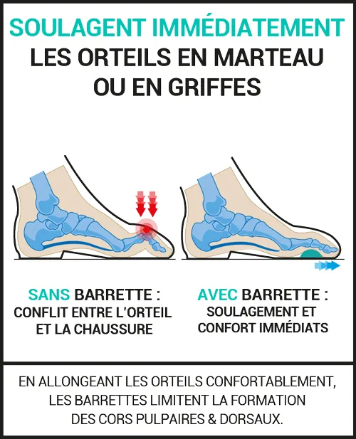 orteils en marteau griffe epitact