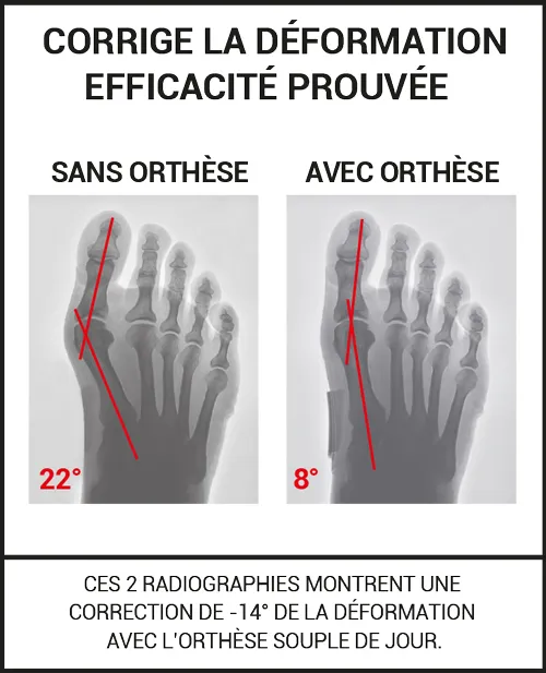 correction avec et sans orthèse hallux valgus EPITACT